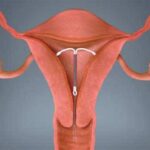 El dispositivo intrauterino o DIU y el bloqueo de la energía  (anticonceptivo) DIUcolocado500